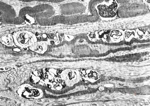 F, 8y. | metachromatic leukodystrophy … n. suralis